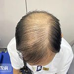 PST加密植髮