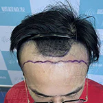 微針加密種植