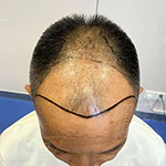 大面積種植
