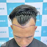 微針加密種植