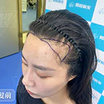 不剃髪植髮