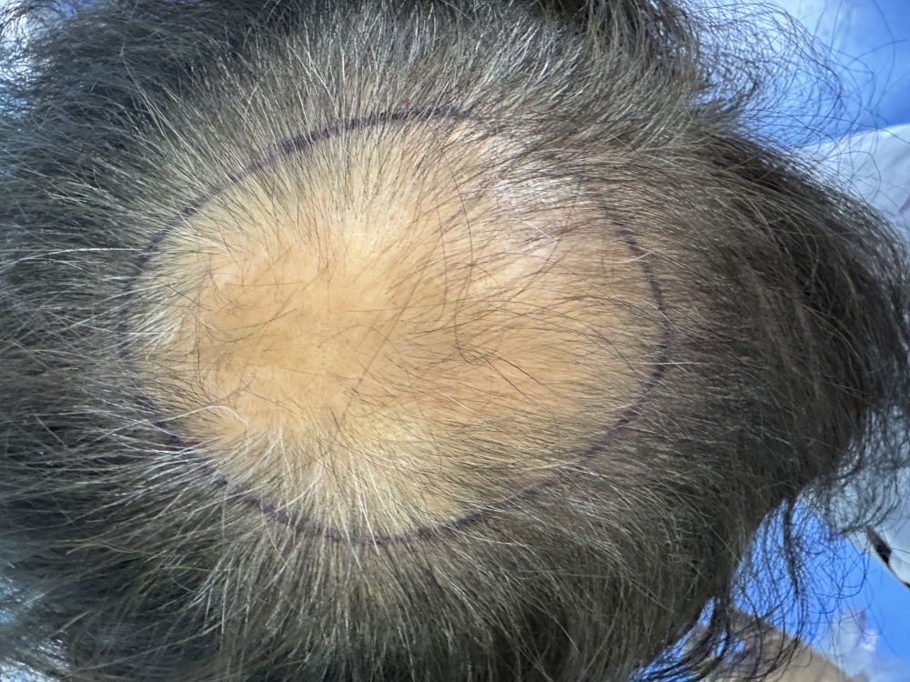 地中海脫髮常見場景