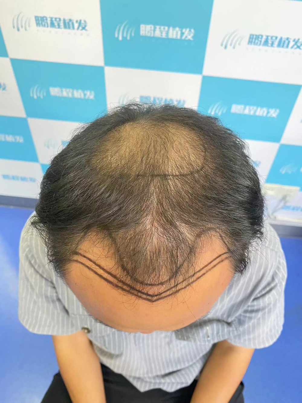 雄激素性禿髮常見症狀示意