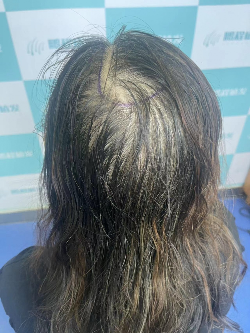 女性脫髮常見原因示意