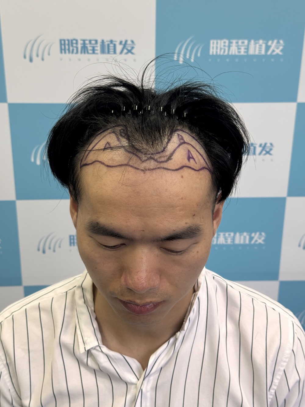 M型发际线后移示意图