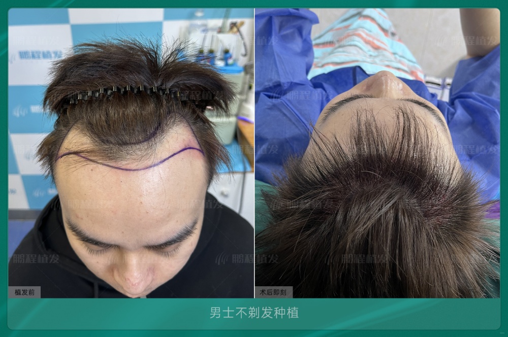 不剃髮植髮術後效果展示