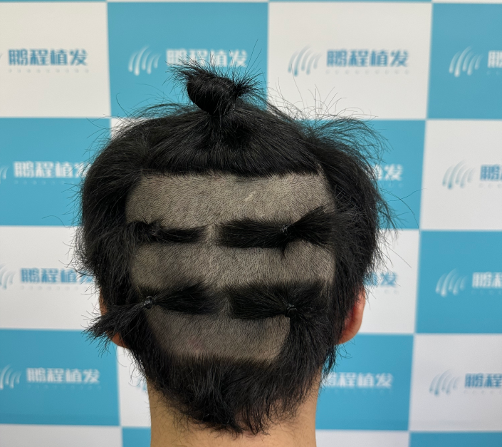 植髮後毛囊生長週期示意圖