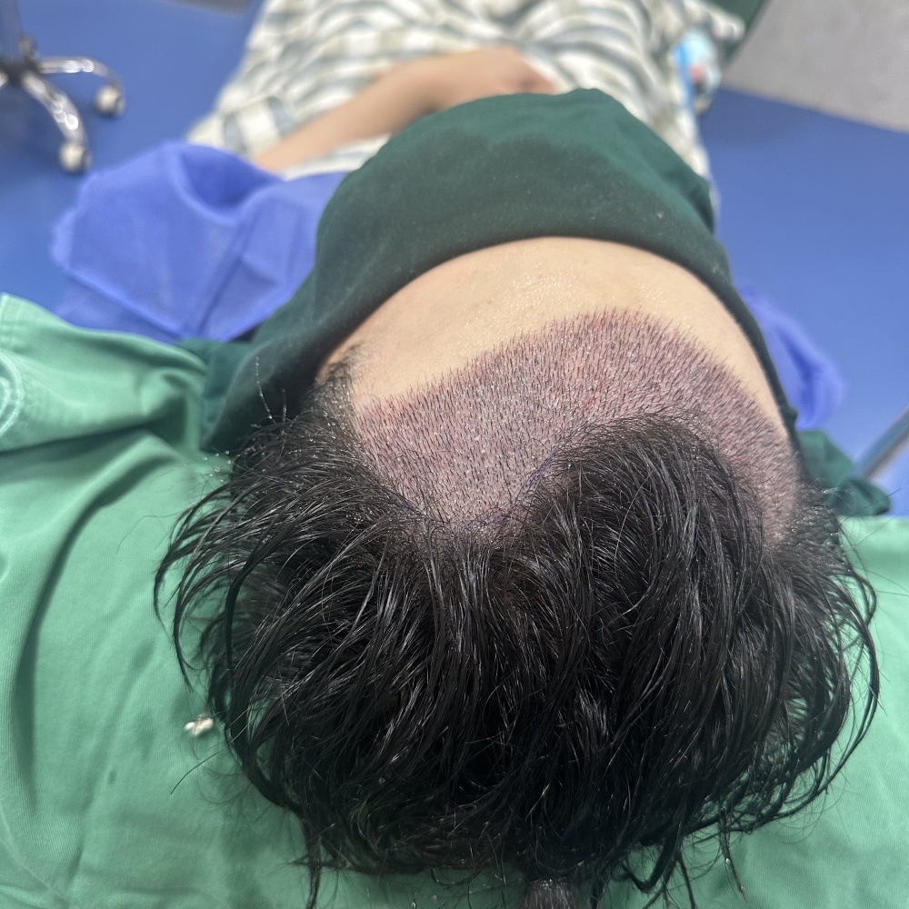 植发后原生发护理示意图