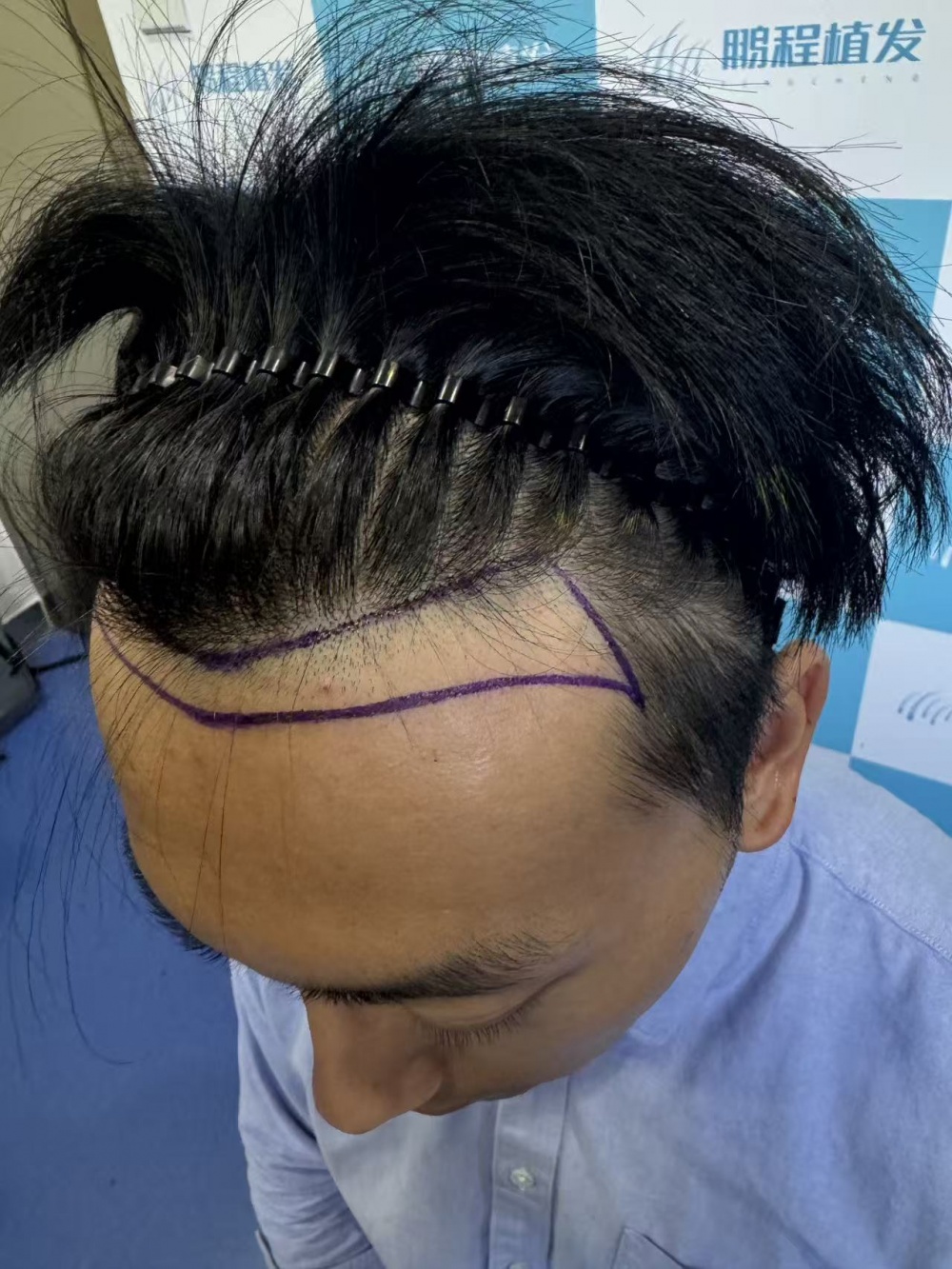 植发密度设计示意图