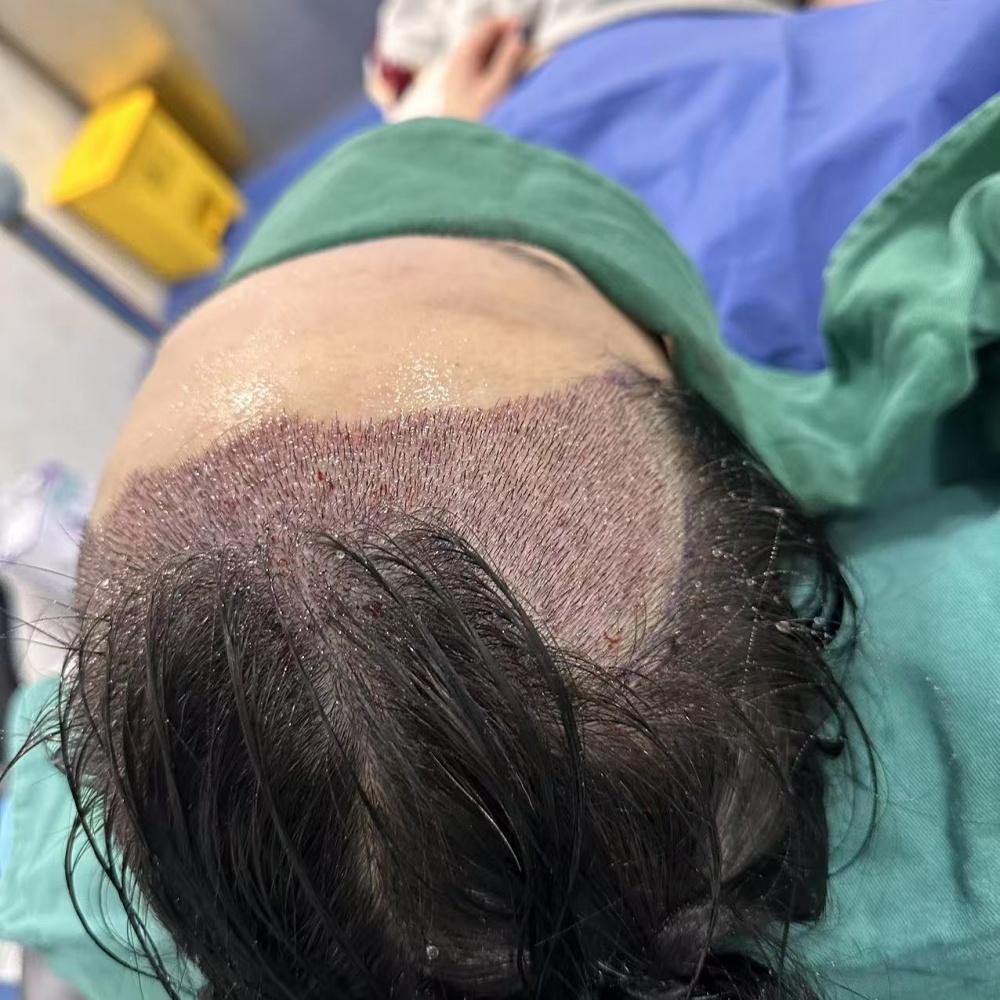 发际线种植术后案例