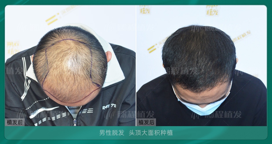 植髮效果前後對比案例