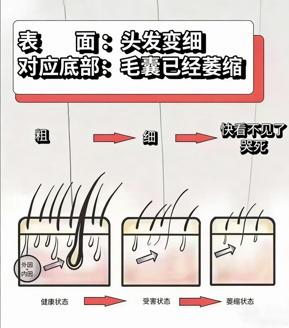 毛囊与脱发关系