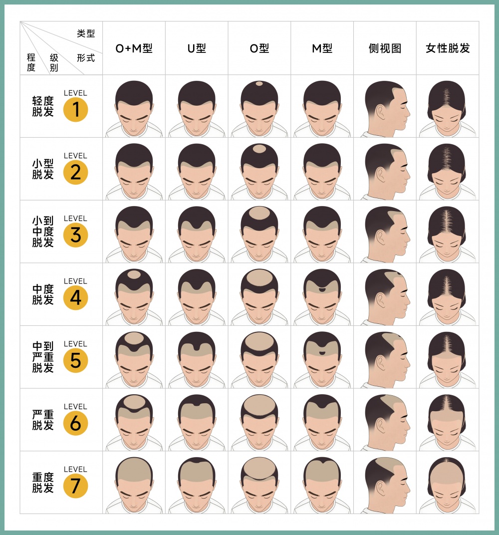 脱发等级