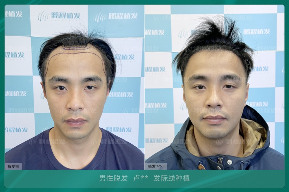 髮際線種植前後面部輪廓對比
