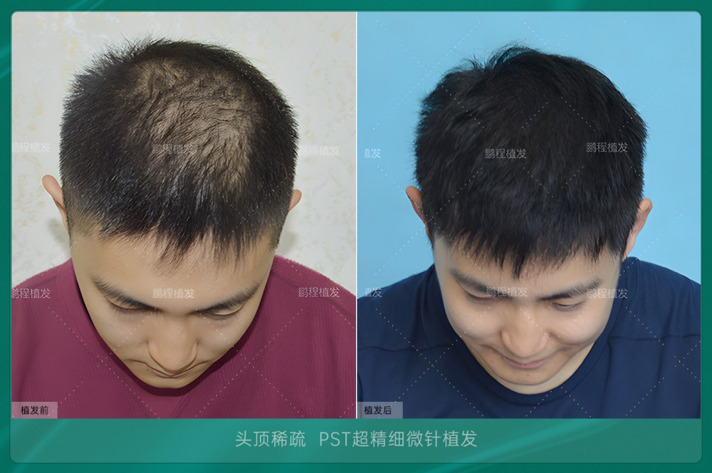 植髮後恢復時間線效果示意