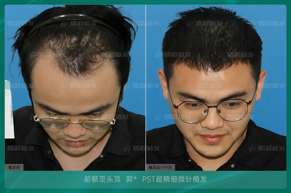 发际线种植效果