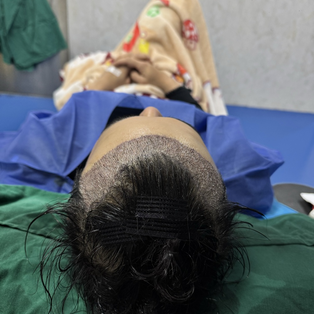 发际线种植即刻效果