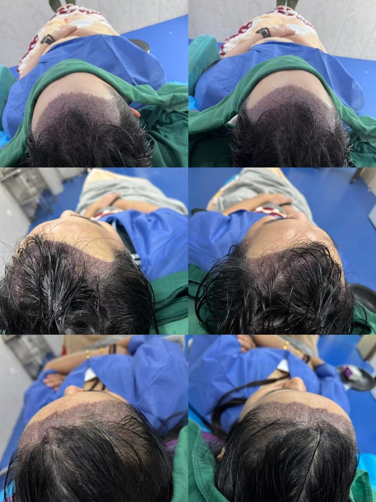 深圳鹏程医院植发即刻效果