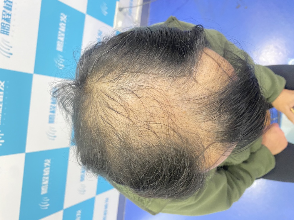 香港年輕人脫髮常見問題科普示意圖