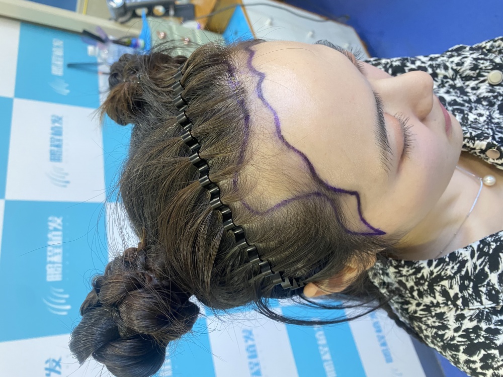 植发术前设计效果