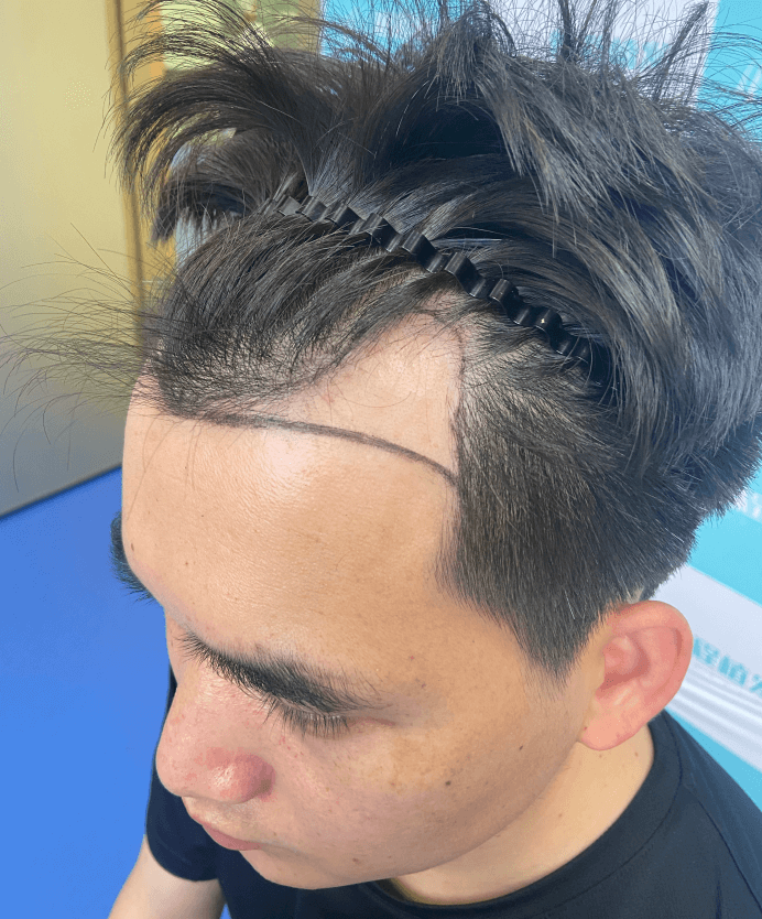 植髮手術術前設計示意圖