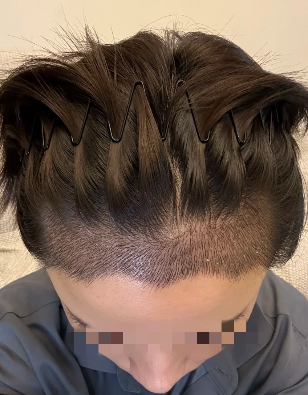 香港植髮不同年齡段效果對比圖