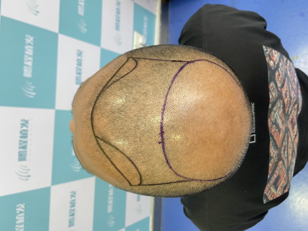 香港脫髮區域示意圖：前額及頭頂易脫髮部位