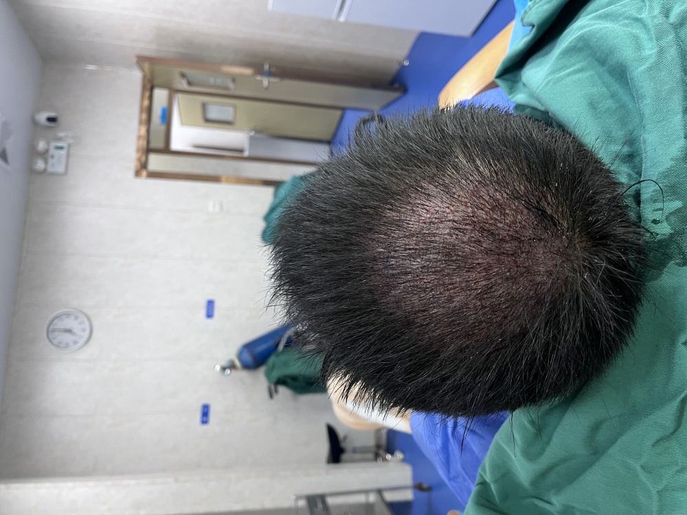 不剃发术后即刻