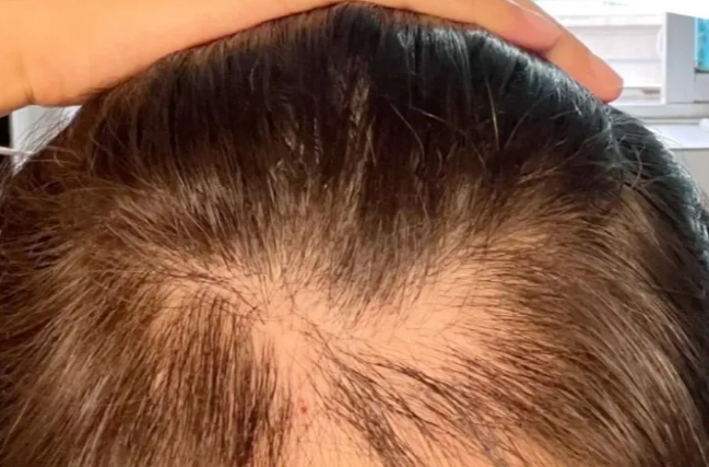 植髮失敗展示圖