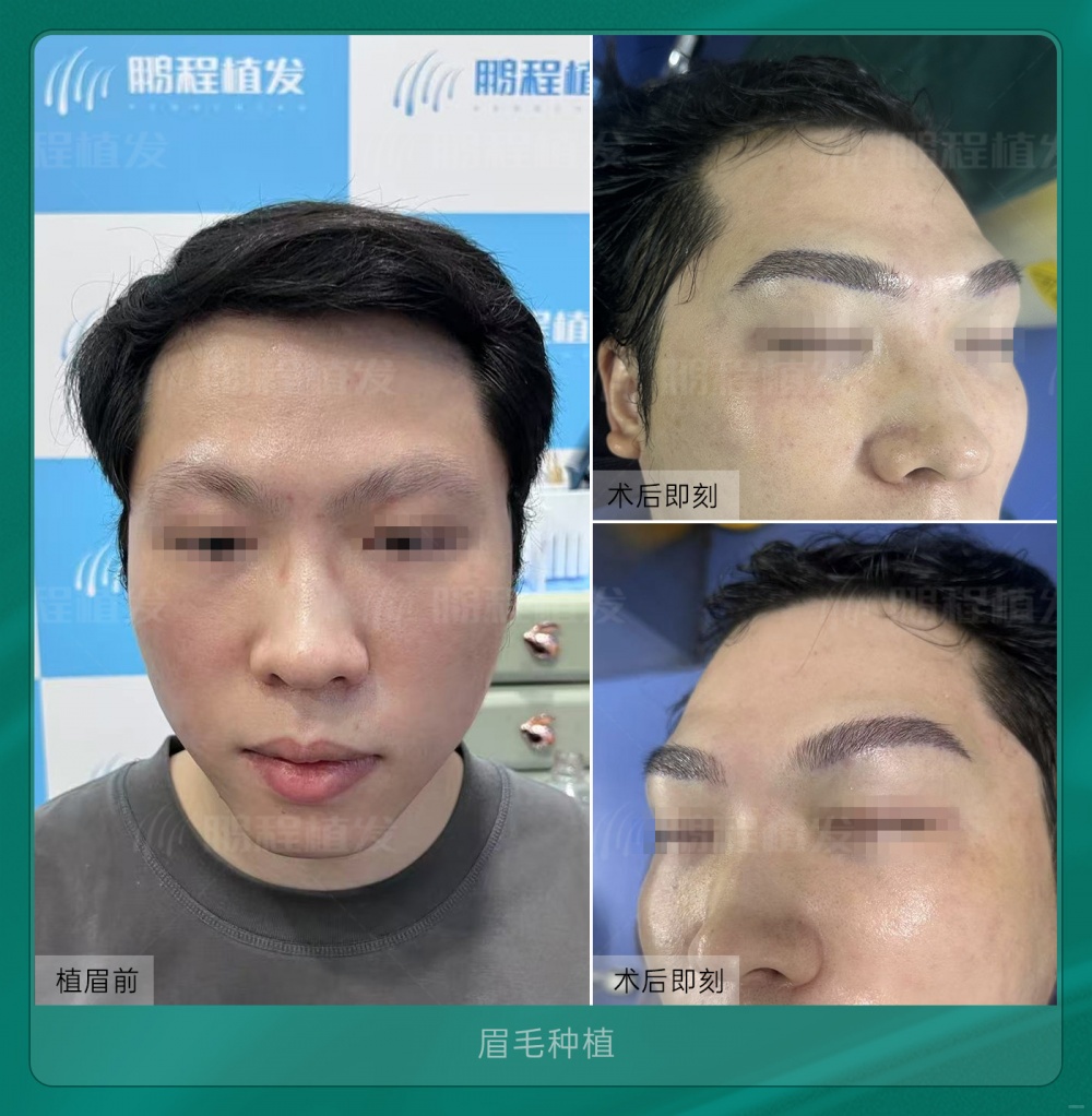 眉毛种植术后即刻