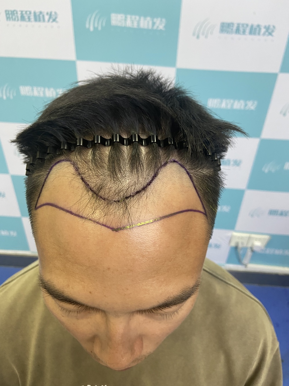 植髮避坑關鍵步驟示意圖