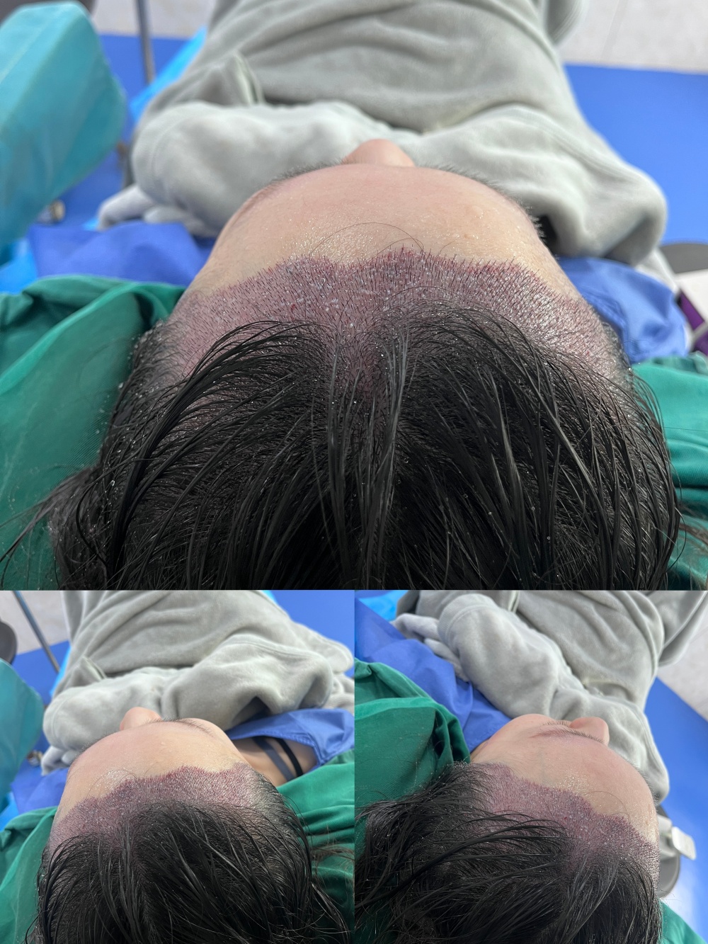 植髪效果