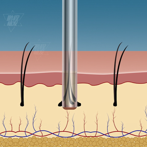 打孔分離毛髮毛囊與供區的聯繫