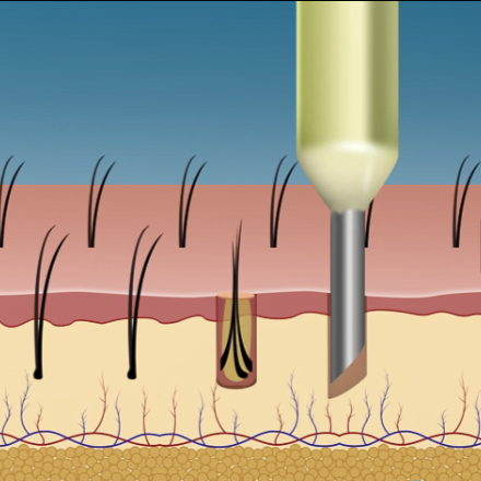 在需要植髮的區域進行毛囊植入