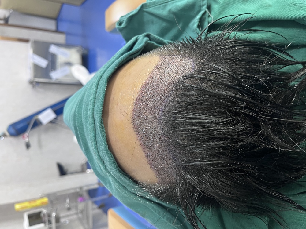 植发术后即刻效果