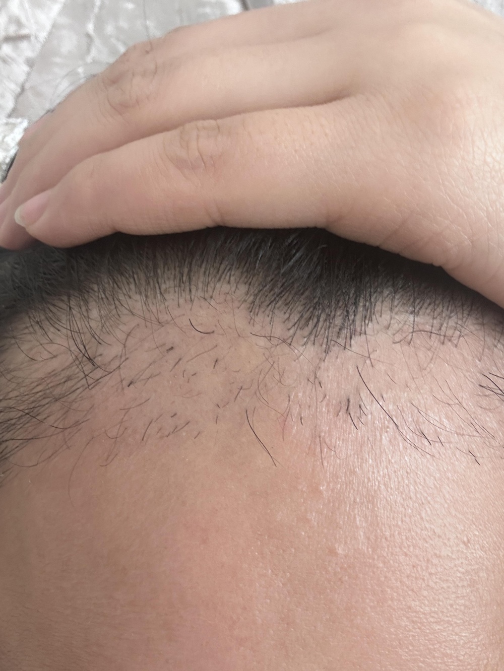 植发失败该怎么办