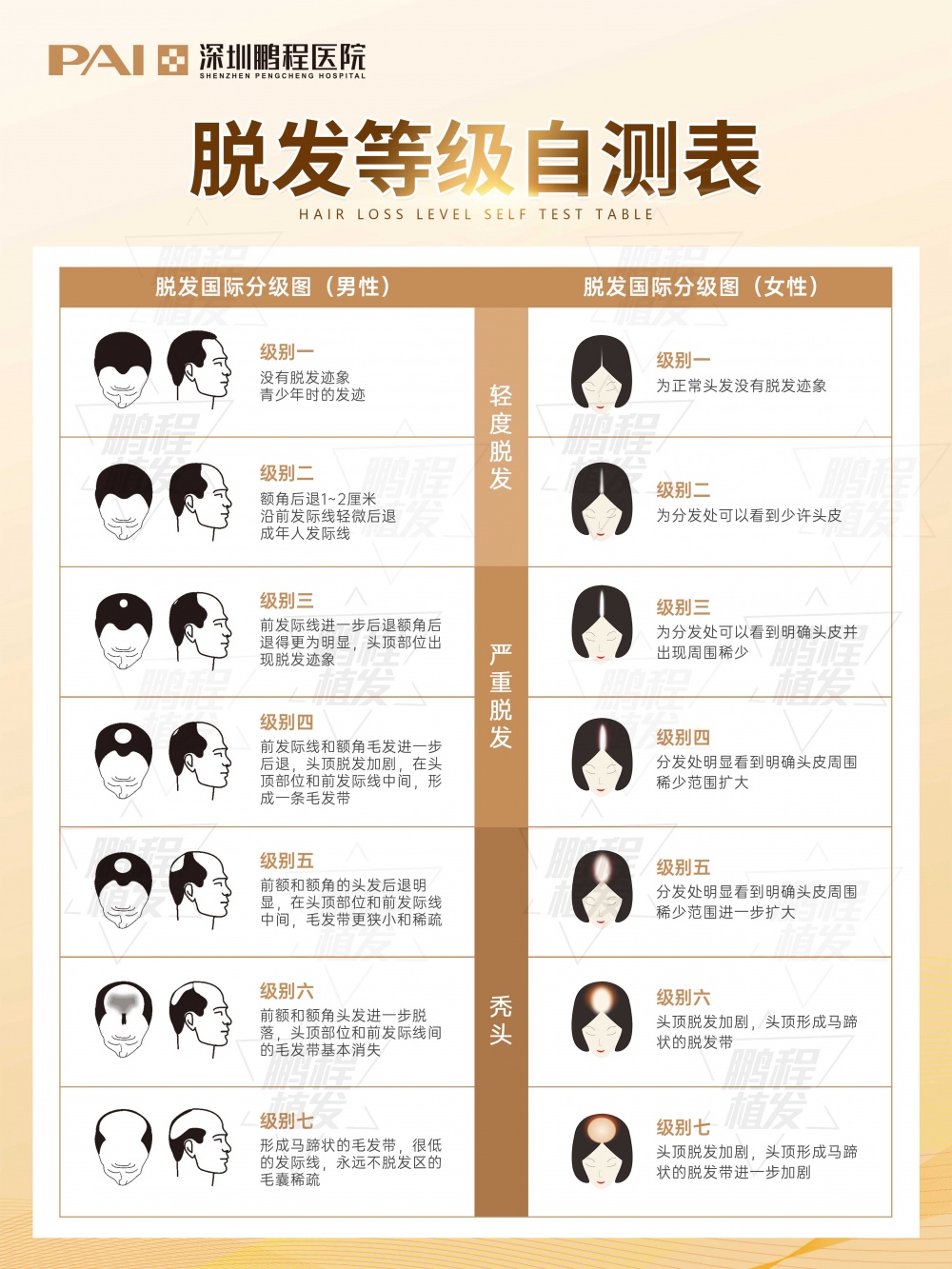 脫髮等級自測圖