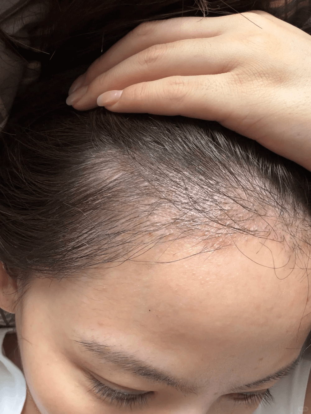 植发失败了怎么办