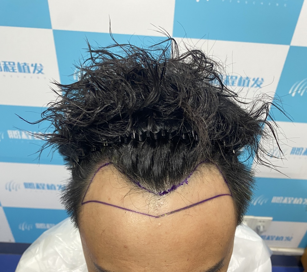 香港髮友植髪