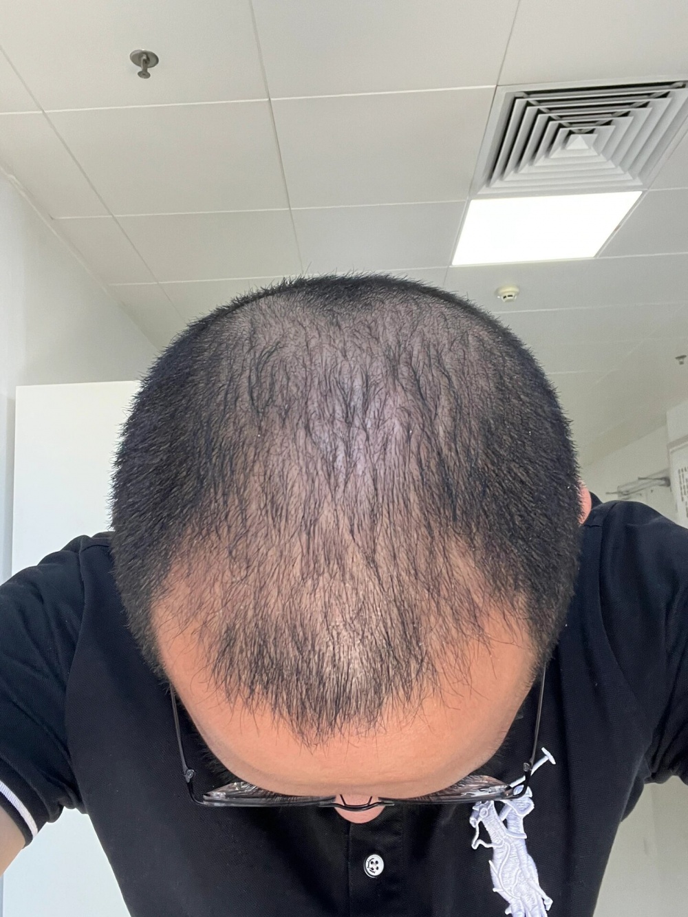 植髪失败