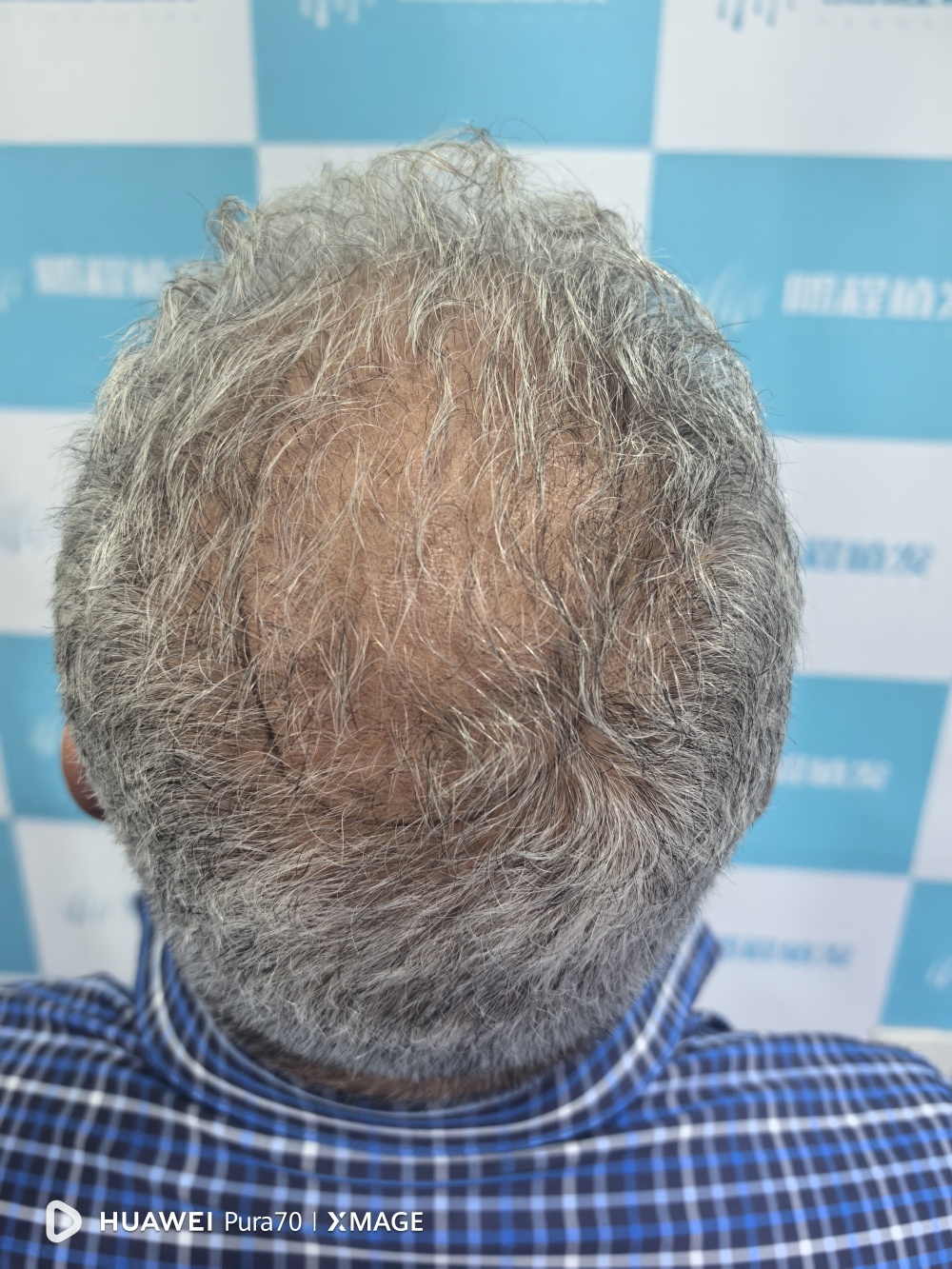 春季植髪黃金期