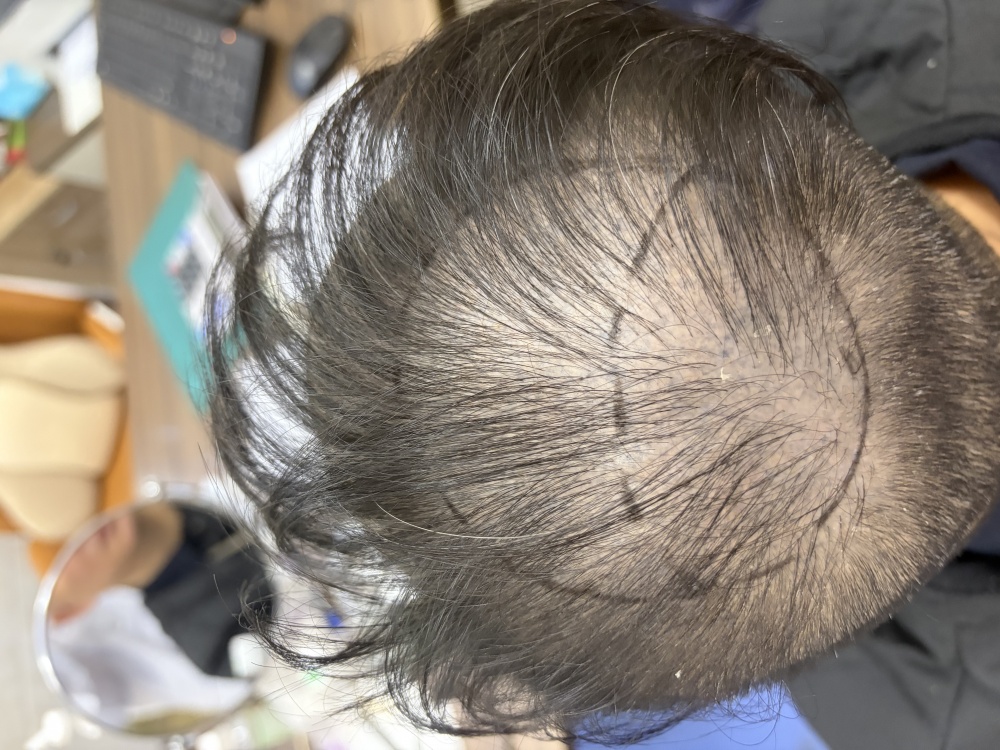 香港常見脫髮類型對比圖