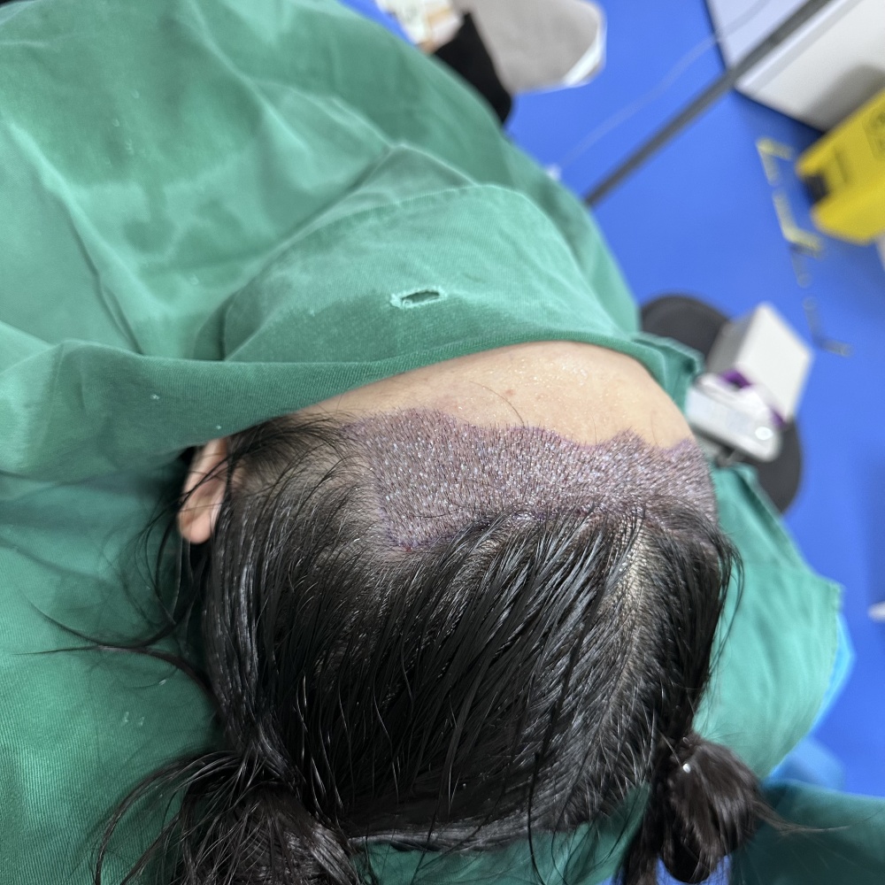 植髪或药物治疗