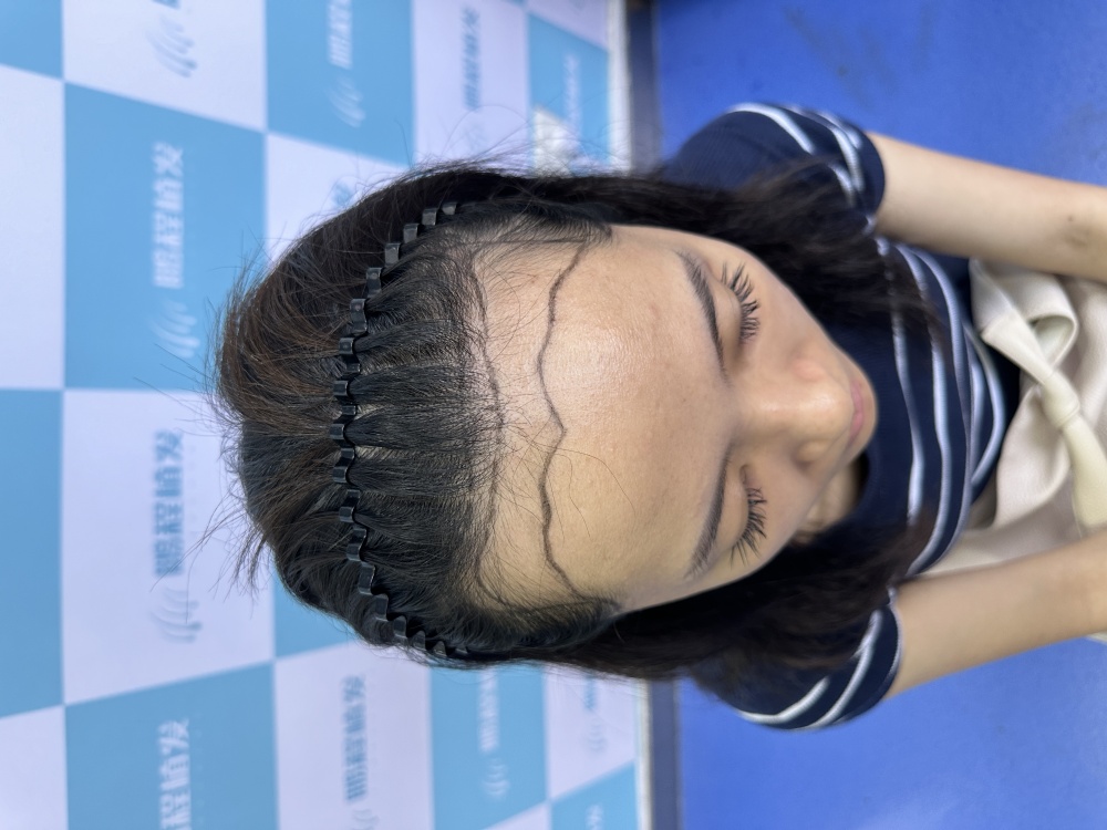 植髮避坑指南 手術前注意事項