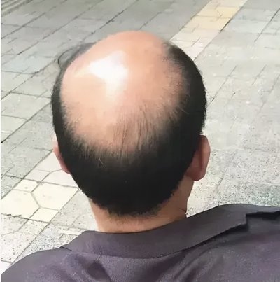 毛囊种植后枕部