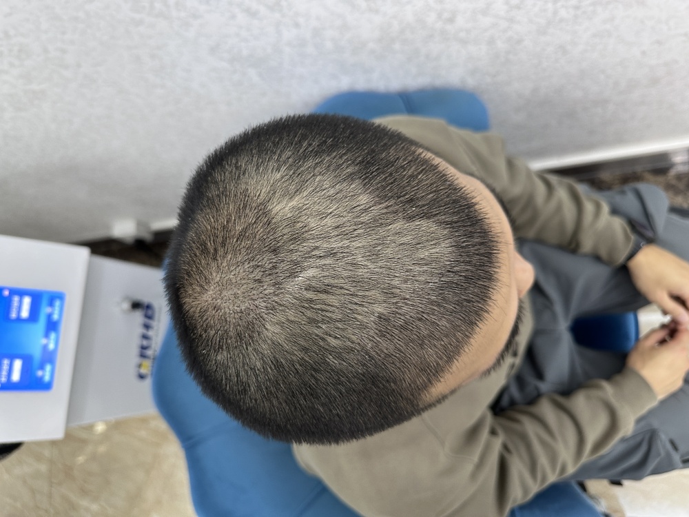 植髪恢复