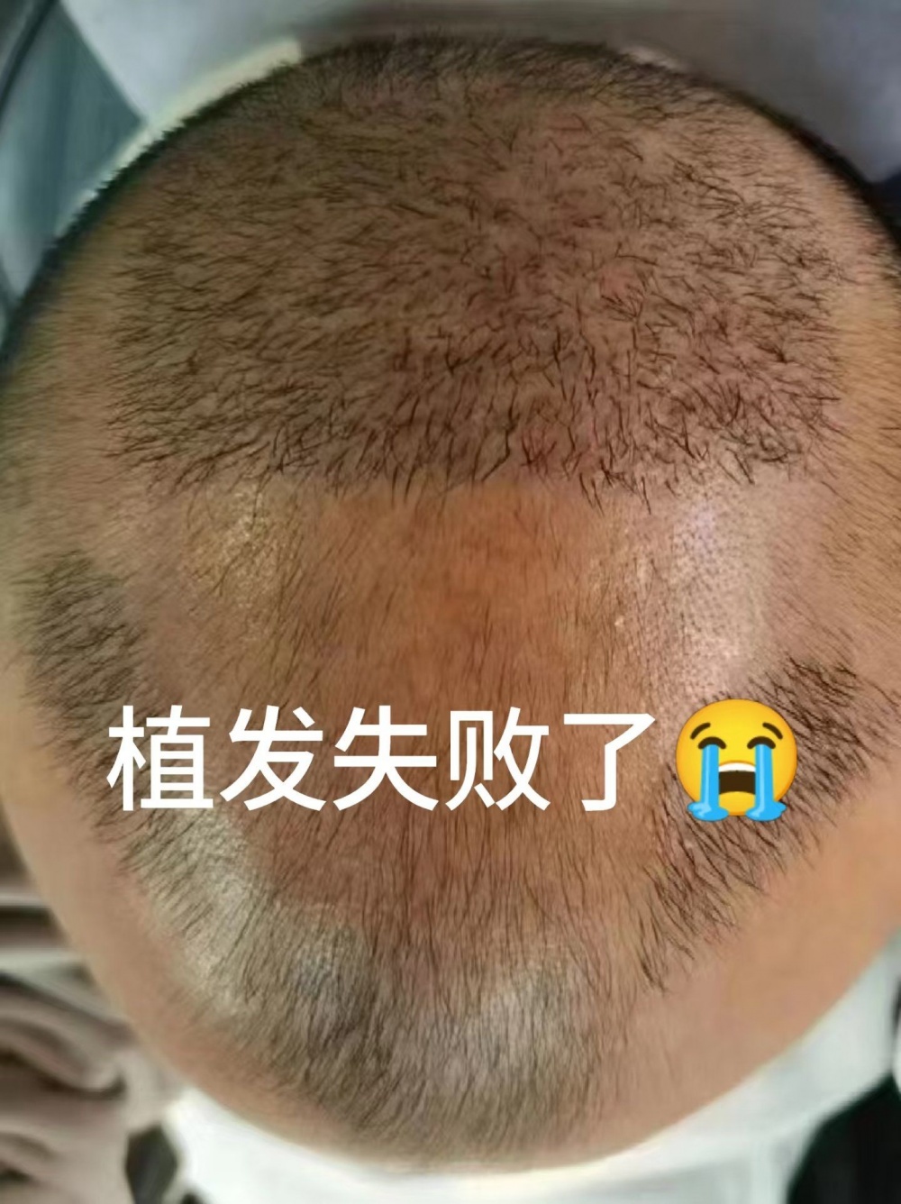 植髪失败