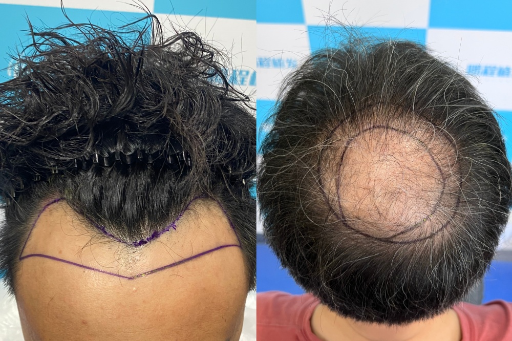 前额秃、头顶稀疏