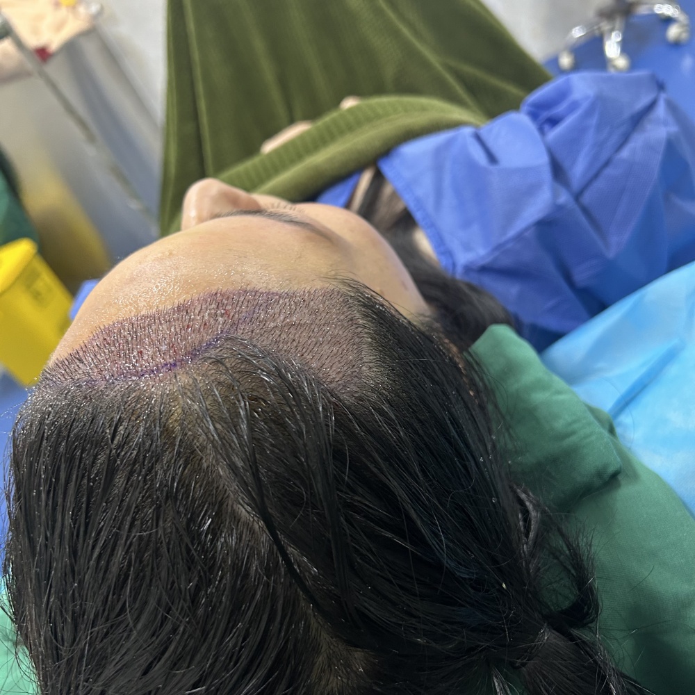 植髮
