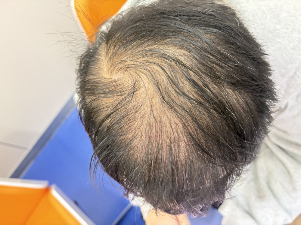 香港脫髮自救指南